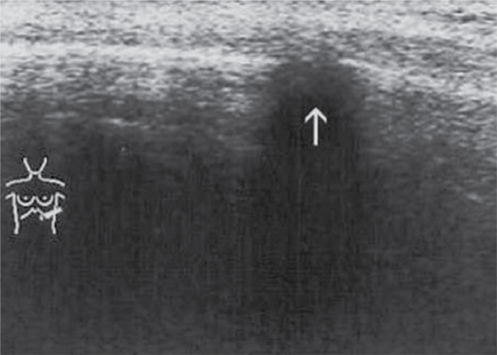 Breast cancer metastasis to the rib (arrow) causes focal bone destruction