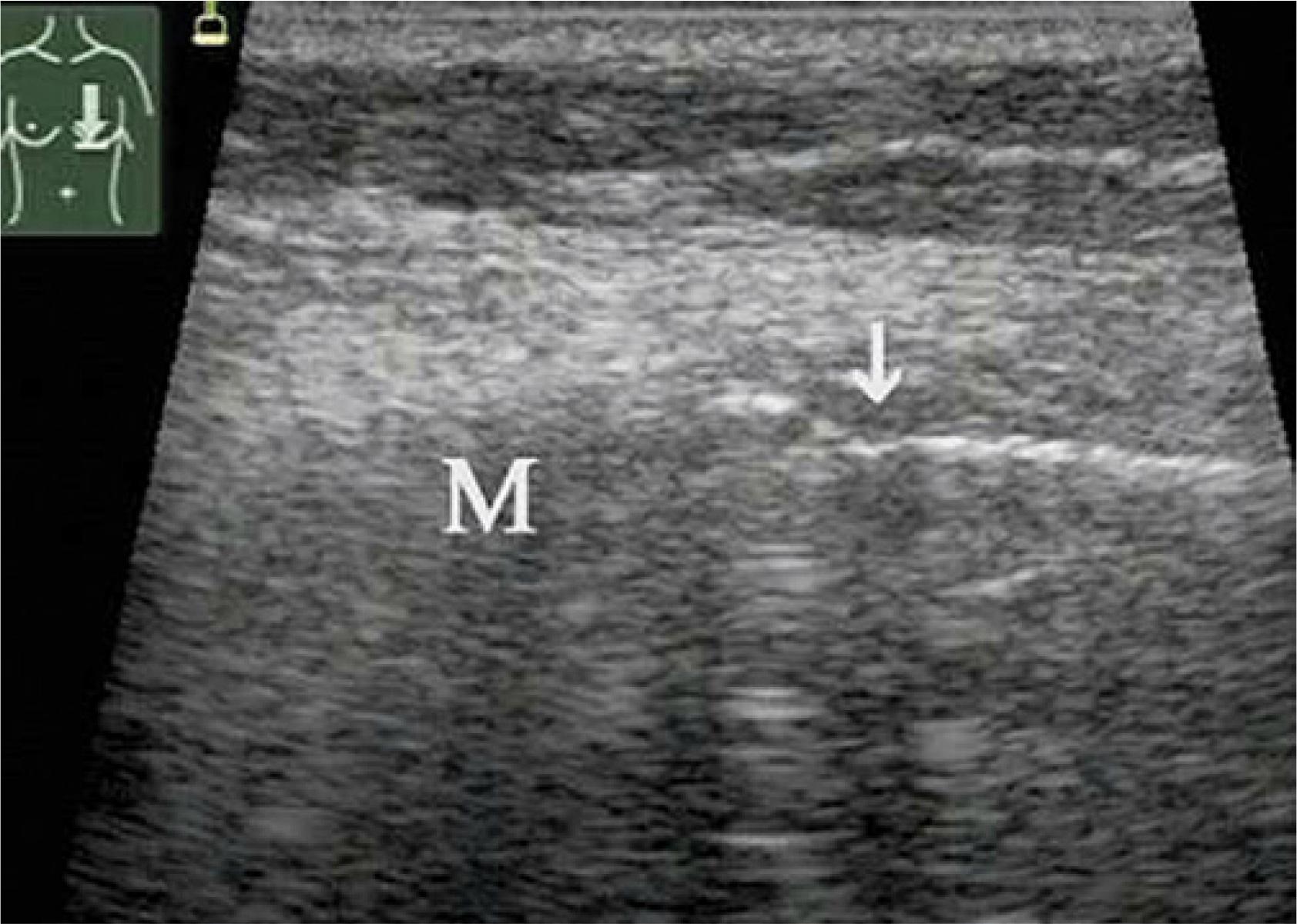 Colon cancer metastasis to the rib (M) with pathological fracture (arrow)