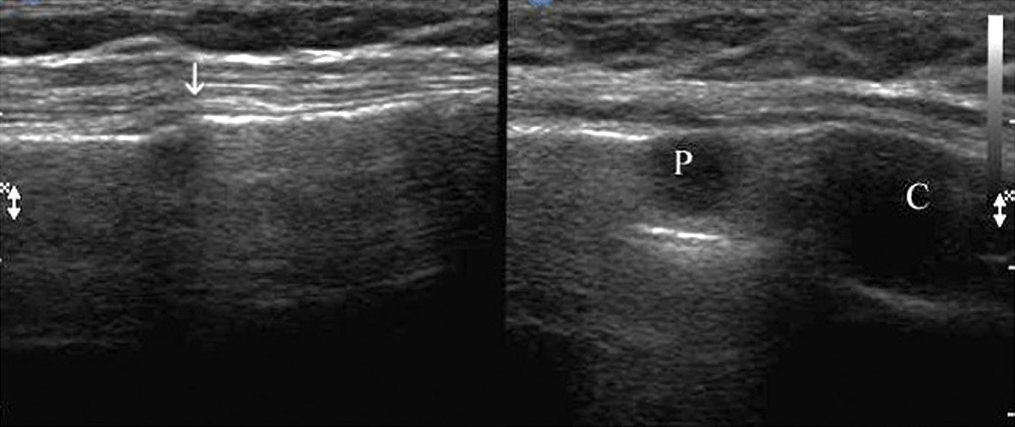 Multiple myeloma. Divided image: only disrupted cortical matter (arrow) may be seen on the left side; again on the right – the same image from the edge of the upper rib shows focal bone destruction (P). C – costal cartilage