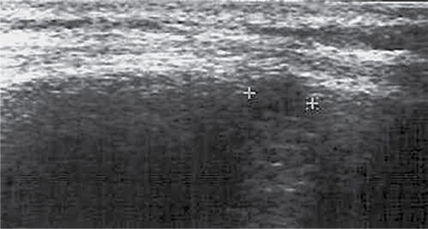 Multiple myeloma. A distinct osteolytic focus involving the whole bone thickness (distance indicators)