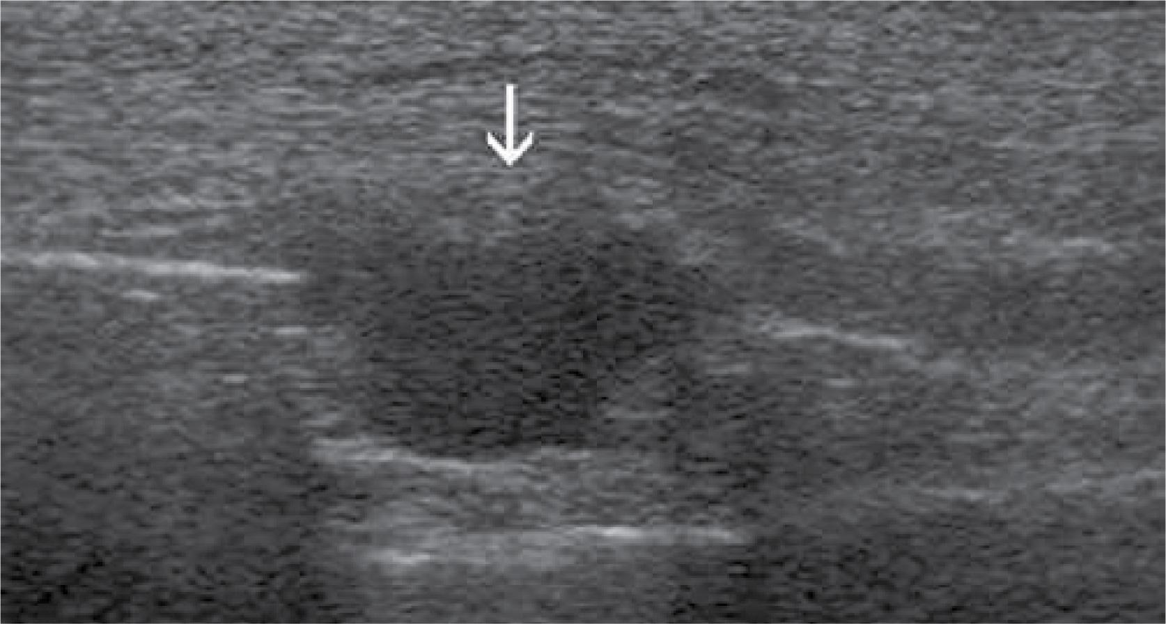 Multiple myeloma. Infiltration of the ribs and surrounding soft tissue (arrow)