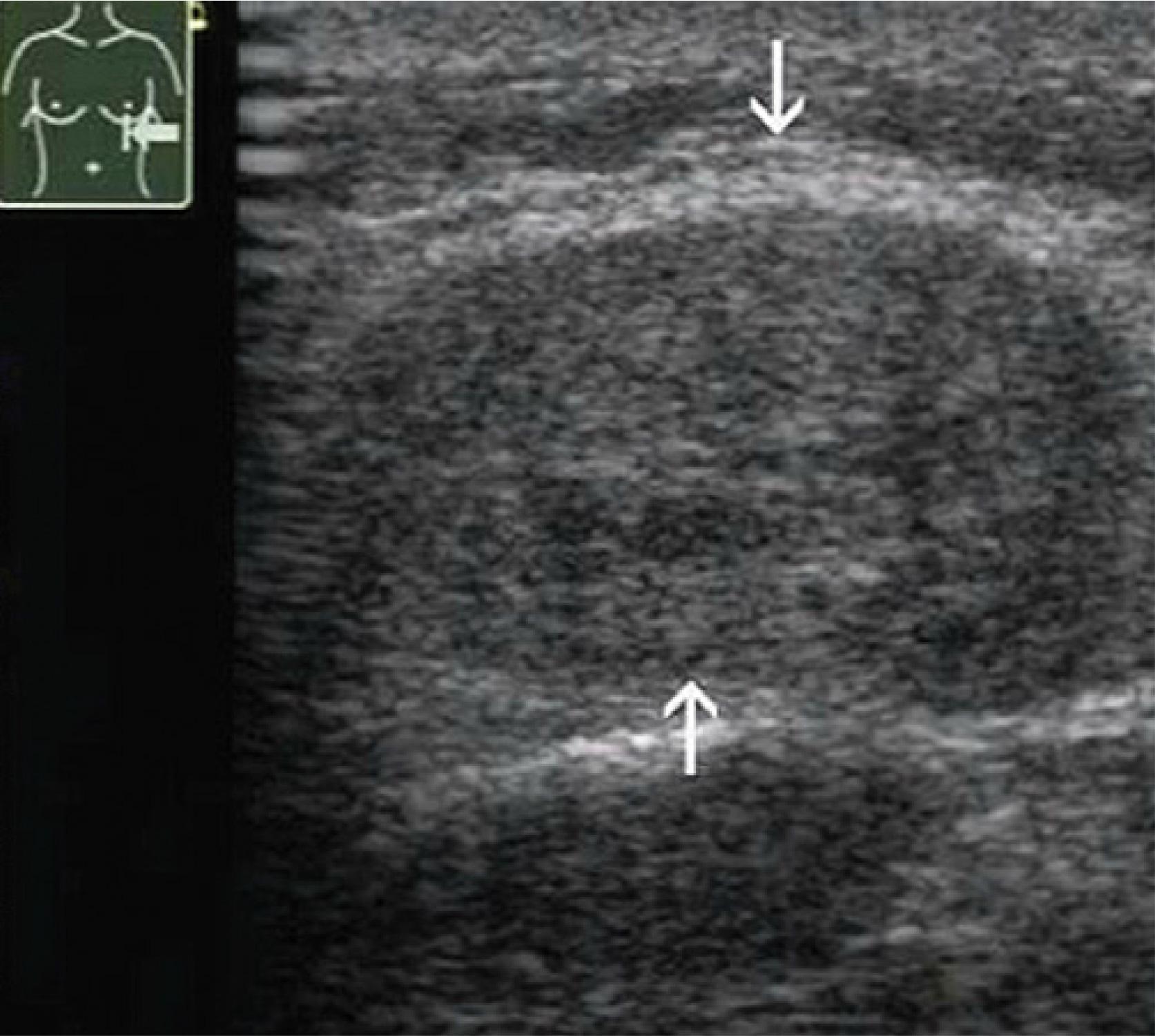 Chondrosarcoma of the cartilage in the left 7th rib