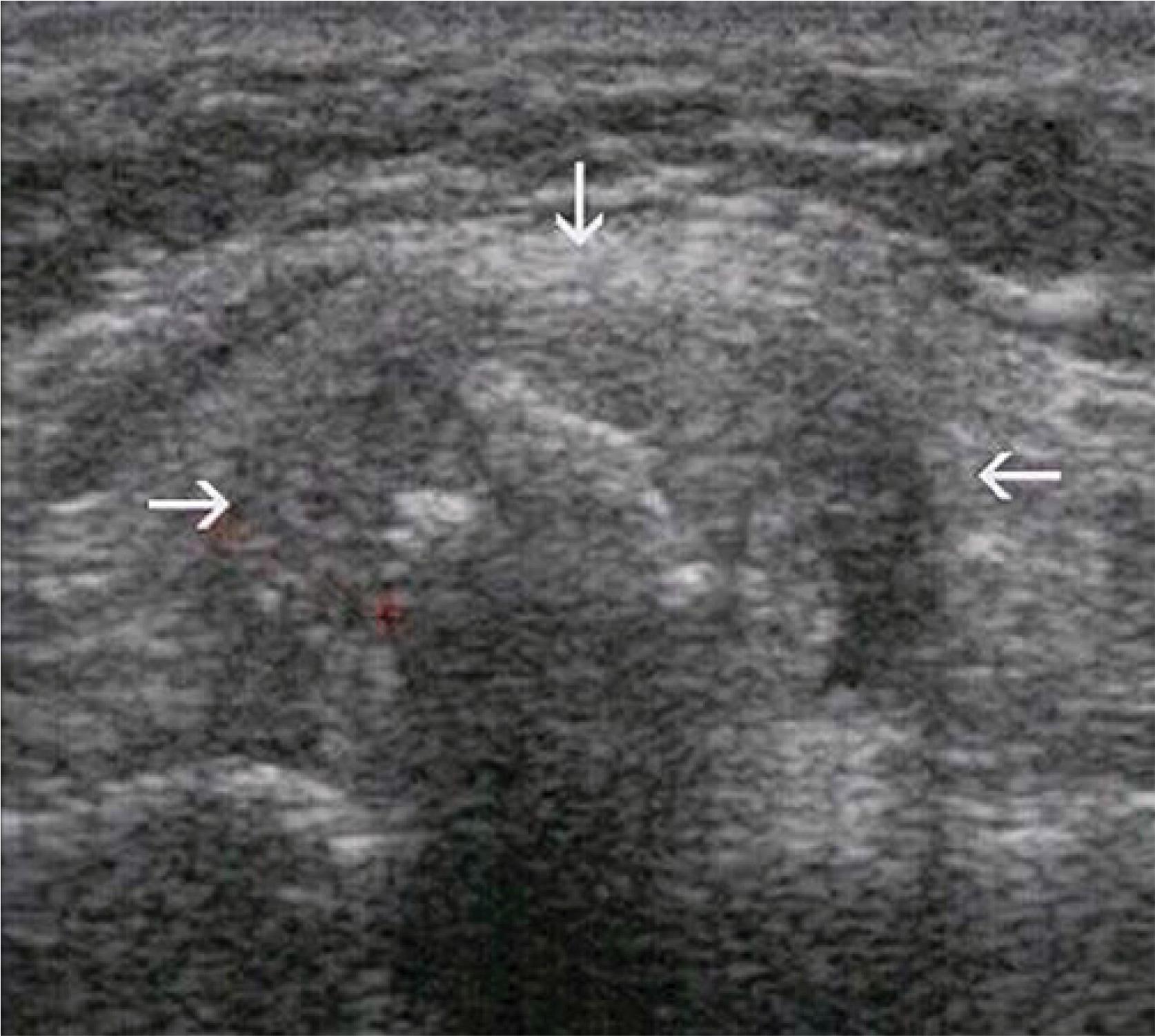 Chondroma of the sternal clavicle (arrows)