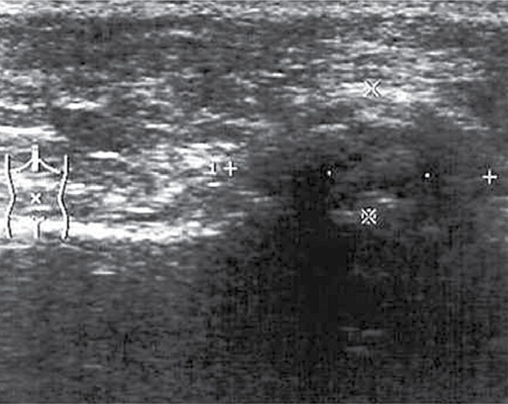 Chondroma of the xiphoid process (distance indicators)