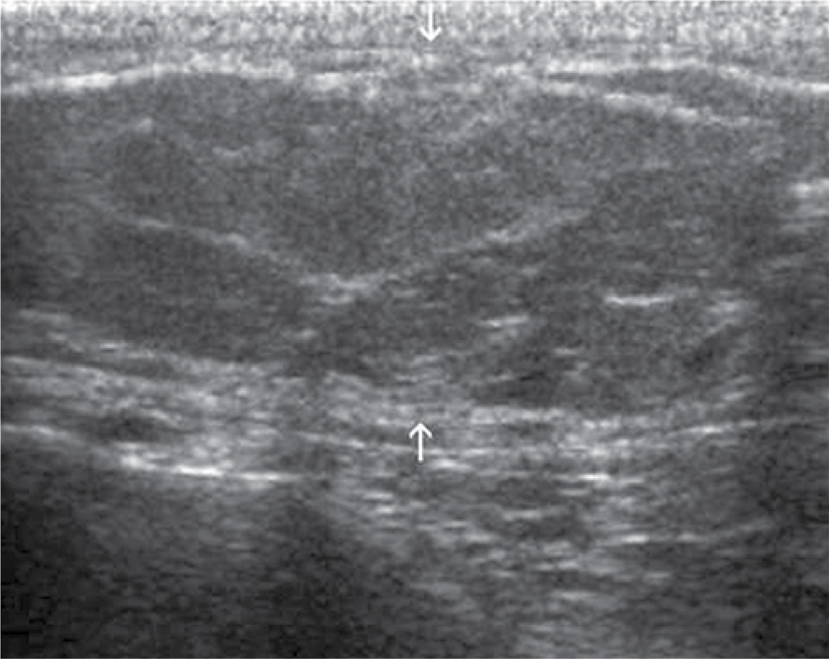 A typical image of lipoma in the subcutaneous tissue of the chest (arrows)