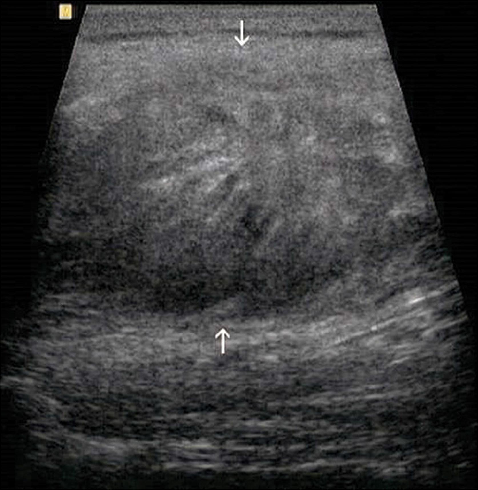 Desmoid fibroma infiltrating chest integuments (arrows)