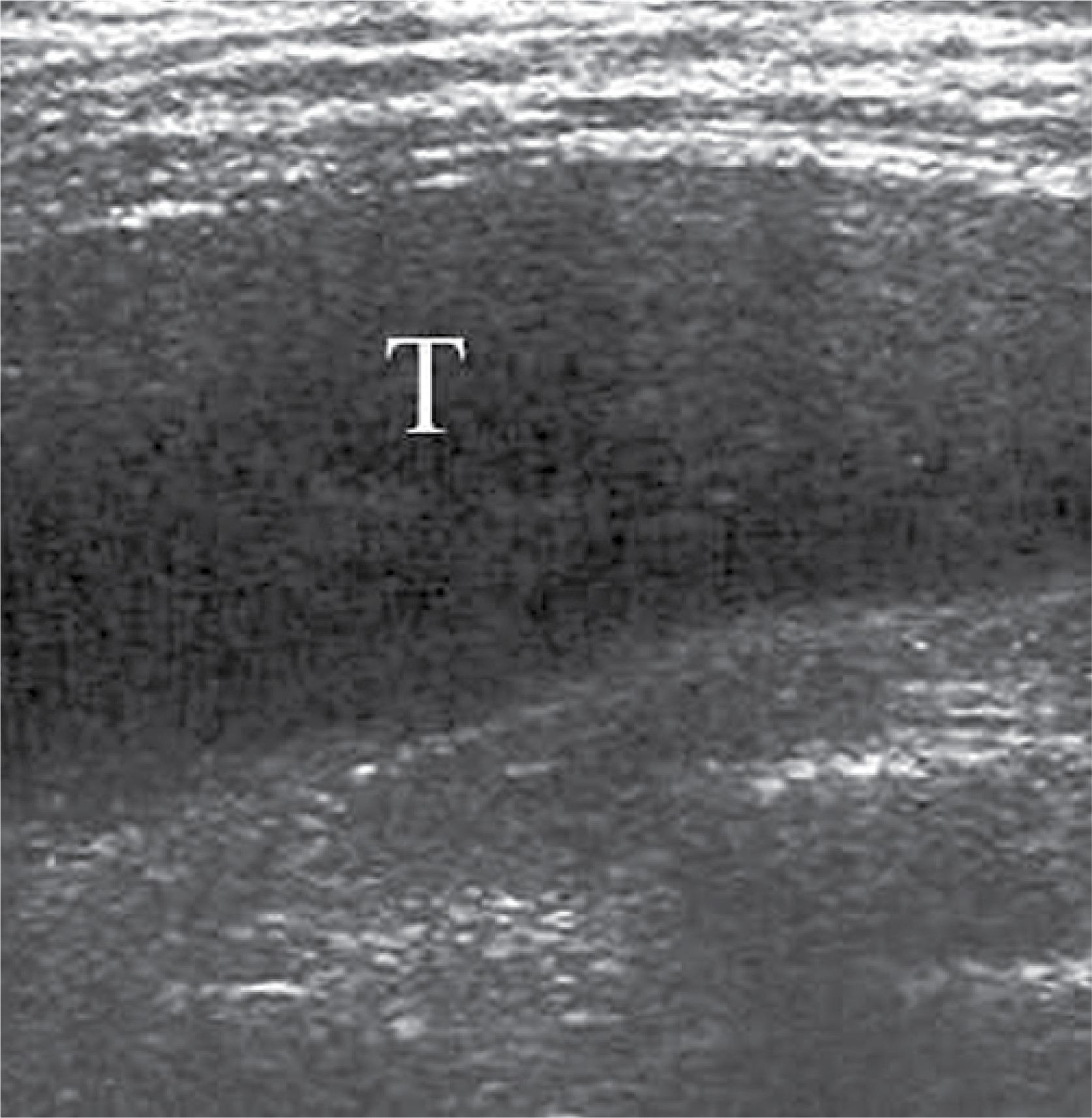 Chondrosarcoma (T) located in the dorsal chest