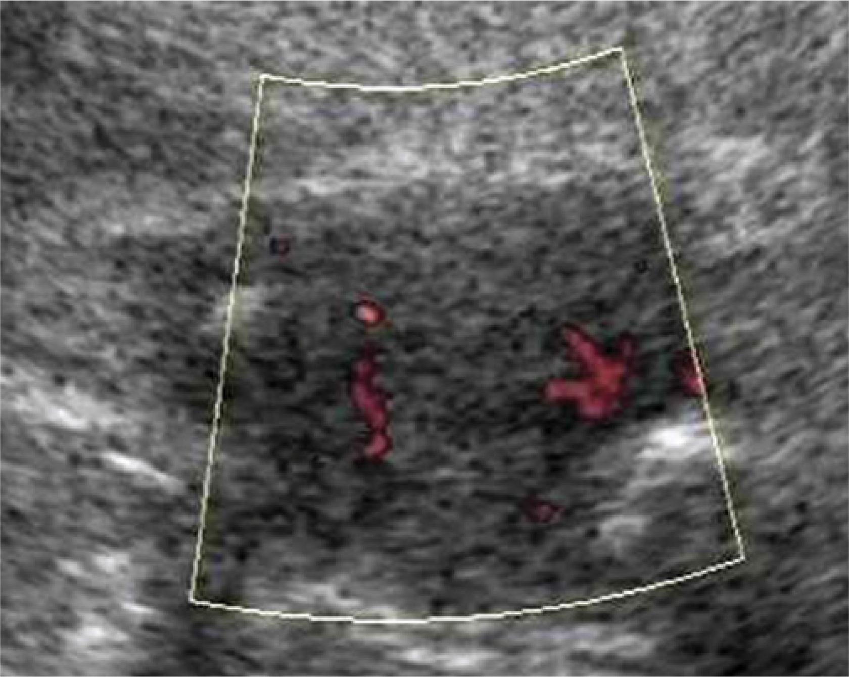 Vascularized metastasis of lung cancer into chest integuments