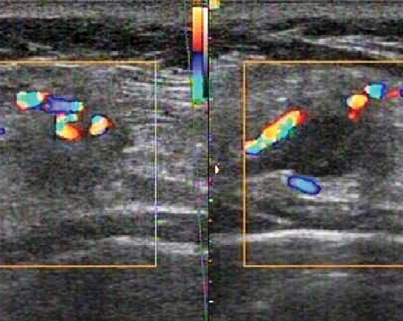 Two cross-sectional views of vascularized metastasis of breast cancer into chest integuments