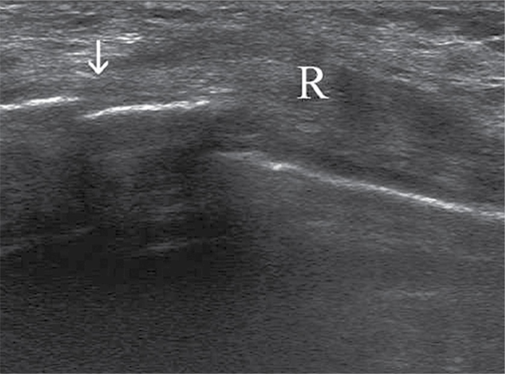 Breast cancer recurrence (R) with pathological rib fracture (arrow)