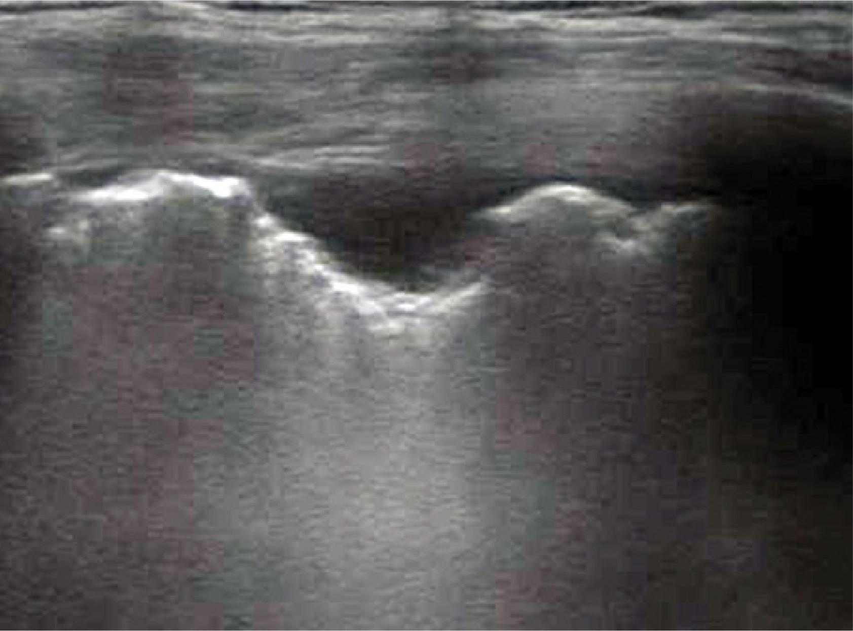 Subpleural metastasis of lung cancer with pleural infiltration