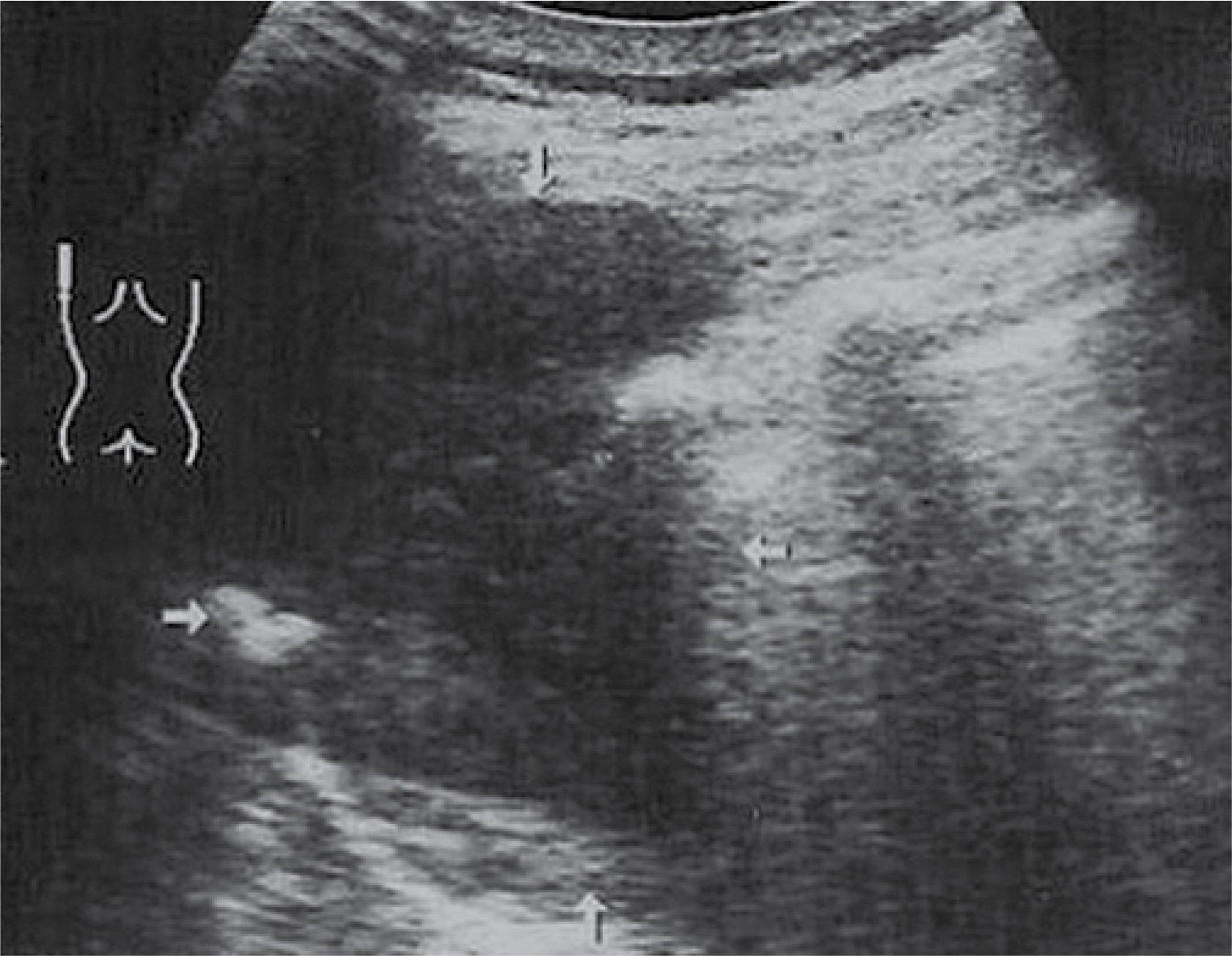 Lung cancer infiltrating almost the entire chest wall and the ribs (arrows)