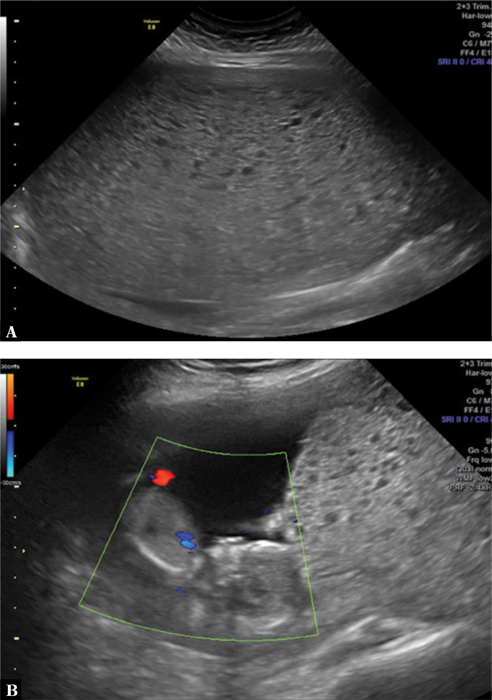 A. A two-dimensional (2D) ultrasound scan shows a uterus filled with heterogeneous echogenic material. B. A 2D ultrasound scan with color Doppler shows a fetus of a gestational age of 14 weeks and a molar aspect of the placenta