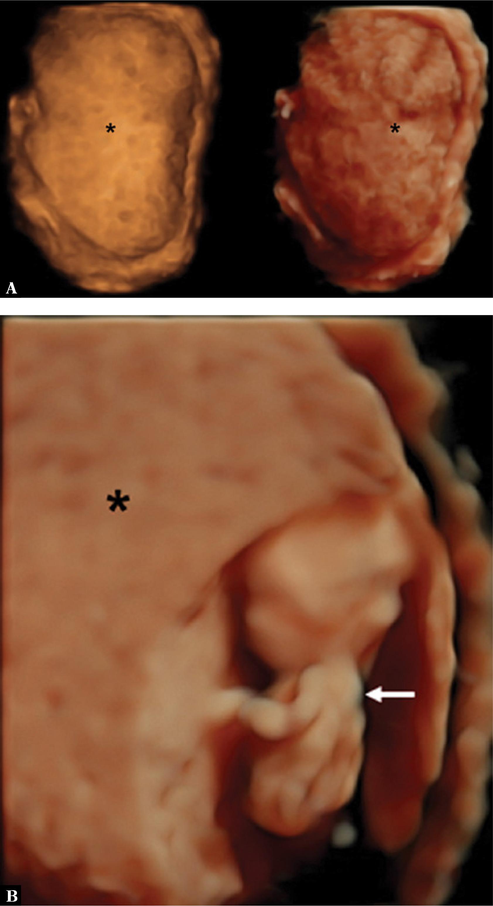 A. A three-dimensional (3D) ultrasound using HDlive rendering mode shows a molar pregnancy (*). B. A 3D ultrasound with HDlive showing a fetus with a gestational age of 14 weeks (arrow) and molar degeneration (*)