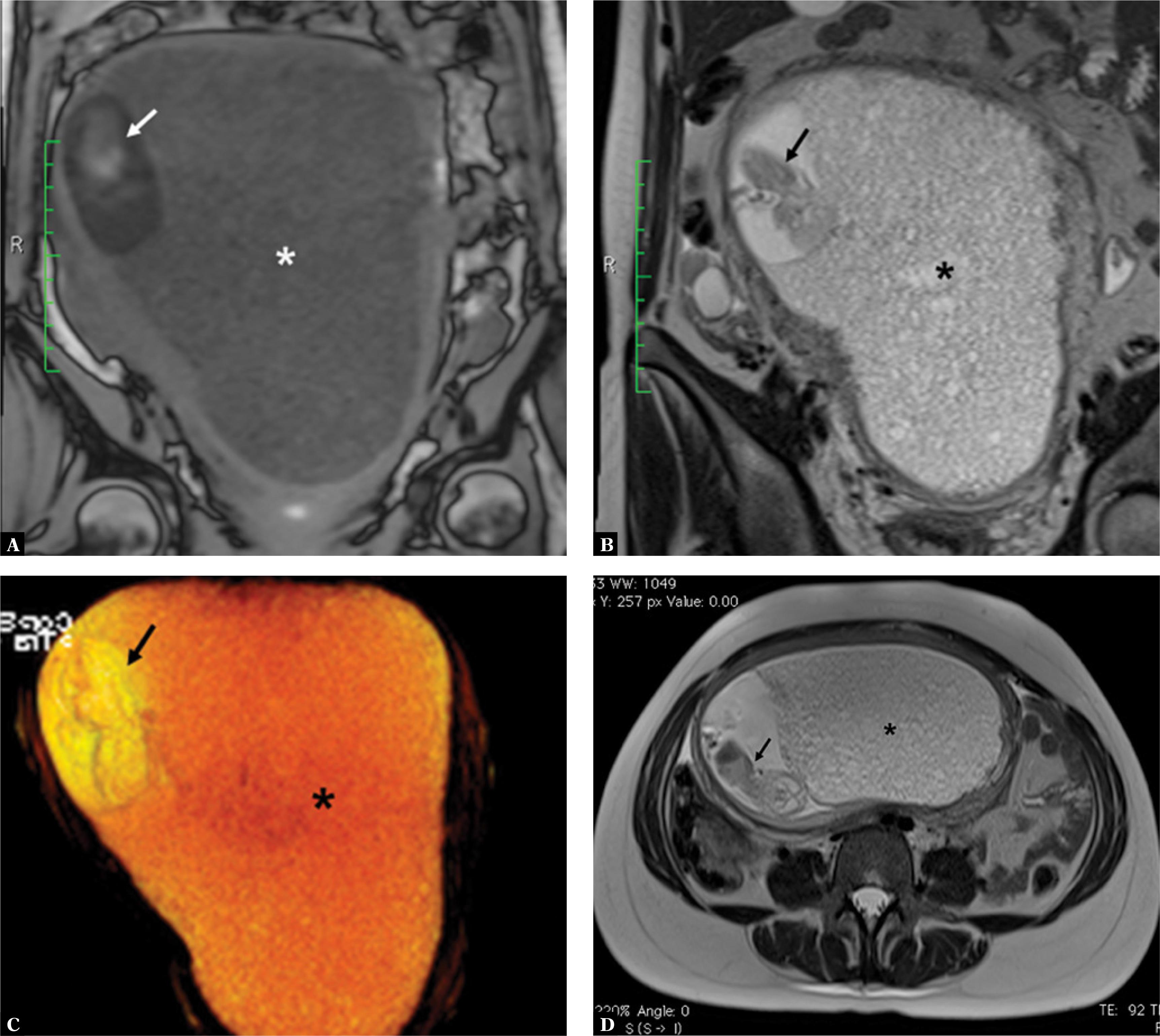 A. Magnetic resonance imaging (MRI; coronal T1-weighted image) shows placental molar degeneration (*) and the fetus (arrow). B. MRI (coronal T2-weighted image) shows placental molar degeneration (*) and the fetus (arrow). C. Three-dimensional (3D) reconstruction from a T2-weighted true FISP sequence (coronal view) showing placental molar degeneration (*) and the fetus (arrow). D. An MRI (axial T2-weighted image) scan shows placental molar degeneration (*) and the fetus (arrow)