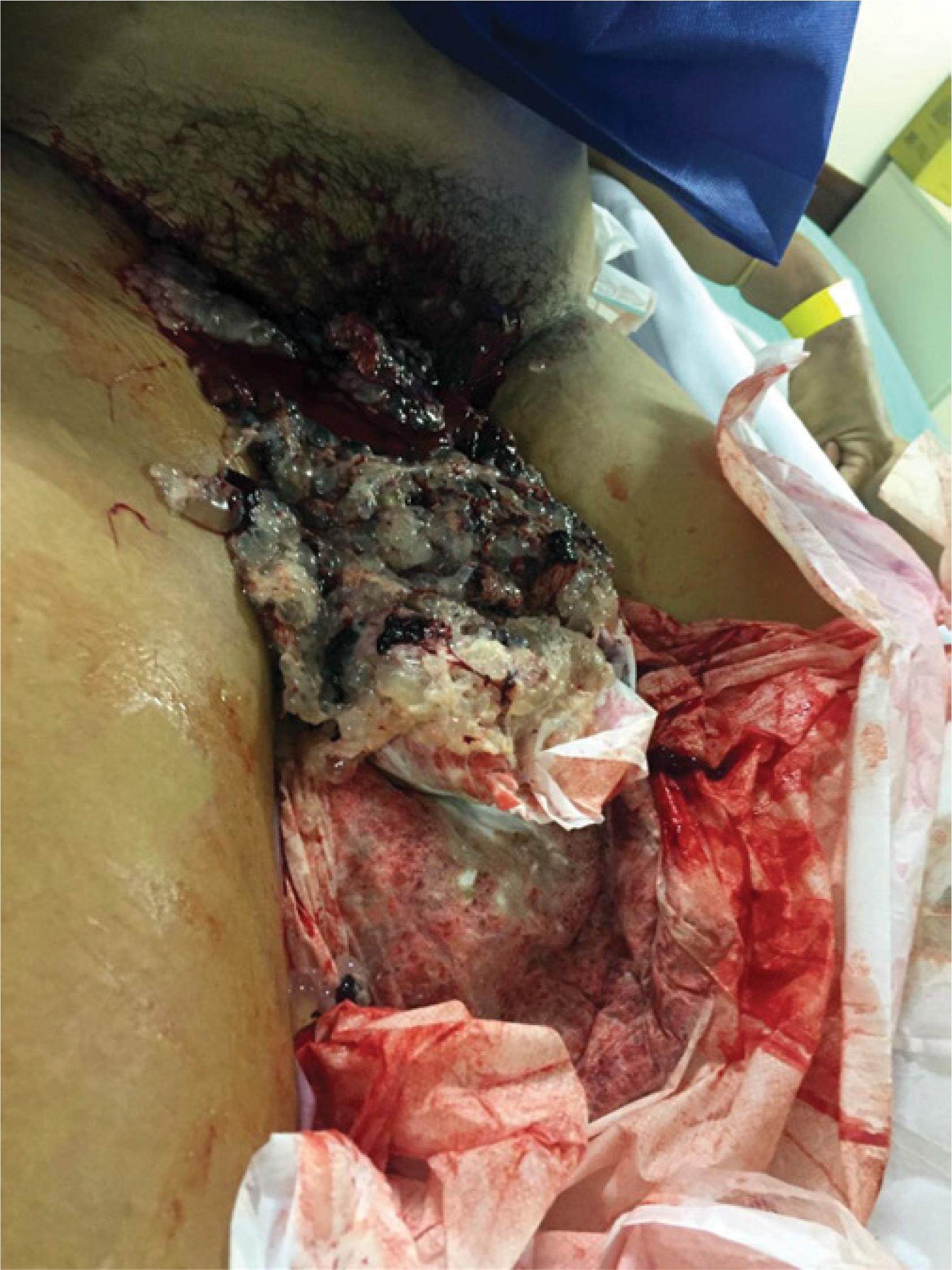 The material removed from the vagina, with macroscopy compatible with the diagnosis of a complete hydatidiform mole