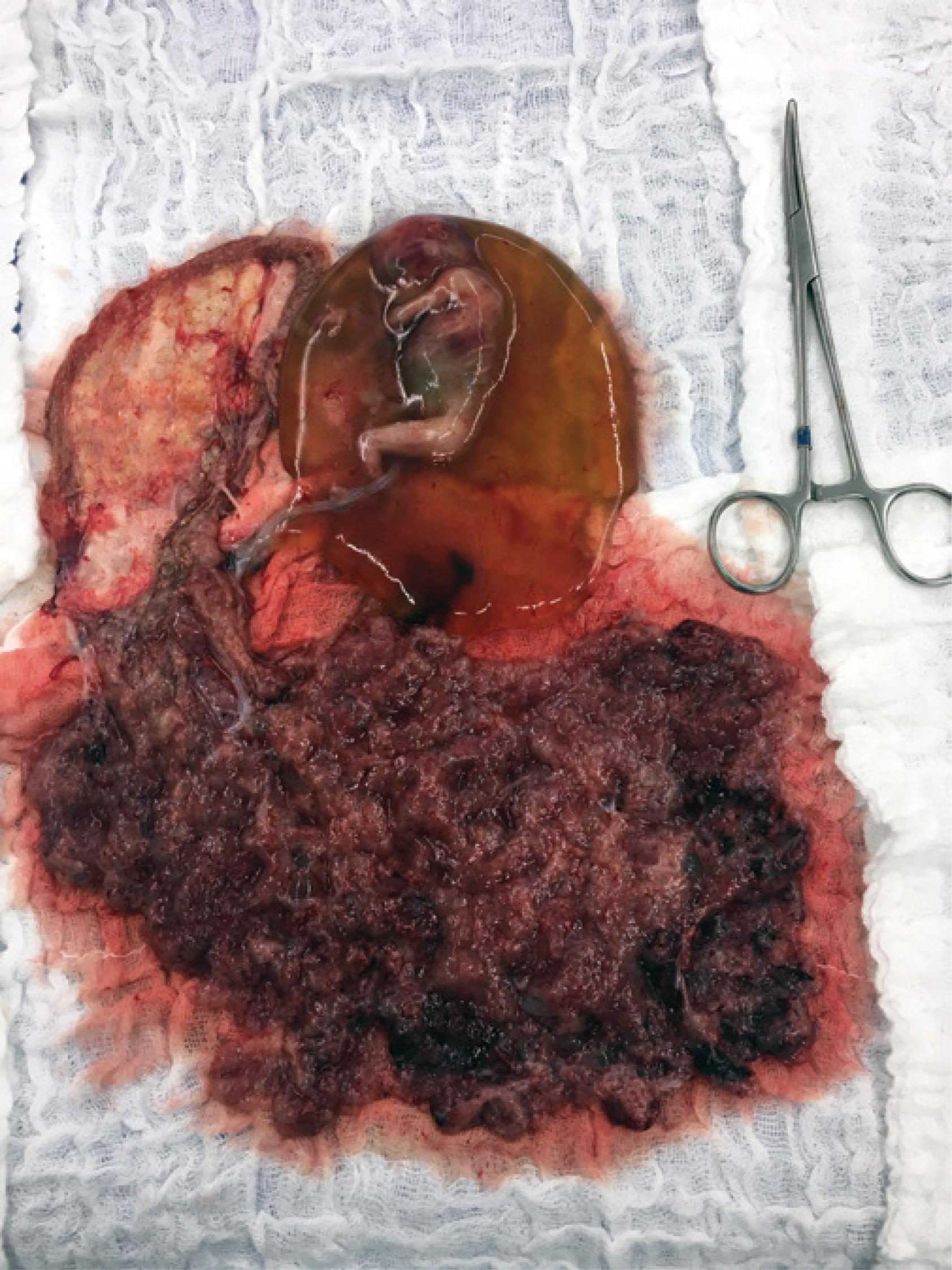 Macroscopy of a twin molar pregnancy. We observed a fertilized ovum represented by normal gestation and another ovum represented by a molar placenta without a conceptual product and appendices, suggesting a complete hydatidiform mole