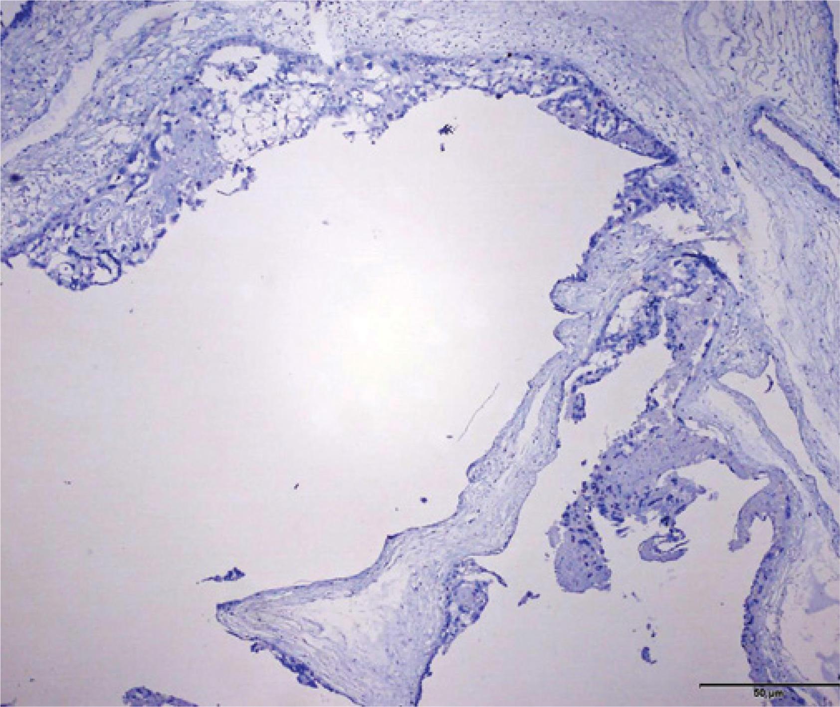 Photomicrography compatible with a complete hydatidiform mole at different magnifications, compatible with a total absence of p57kip2 (Neomarkers, Fremont, CA, USA) expression in villous stromal cells and the cytotrophoblast, which are a product of diandry