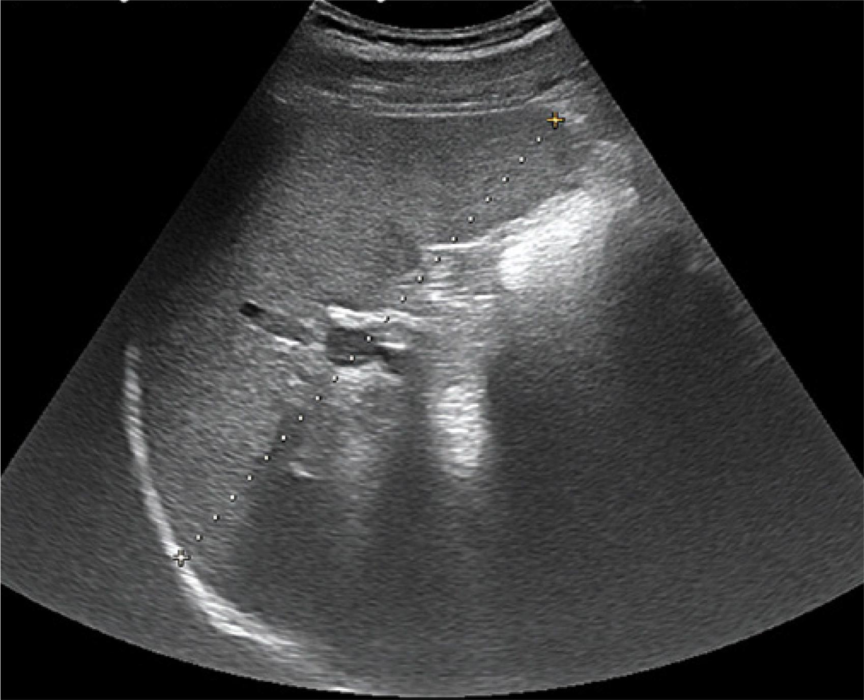 . Measurement of splenic length from the dome to the tip
