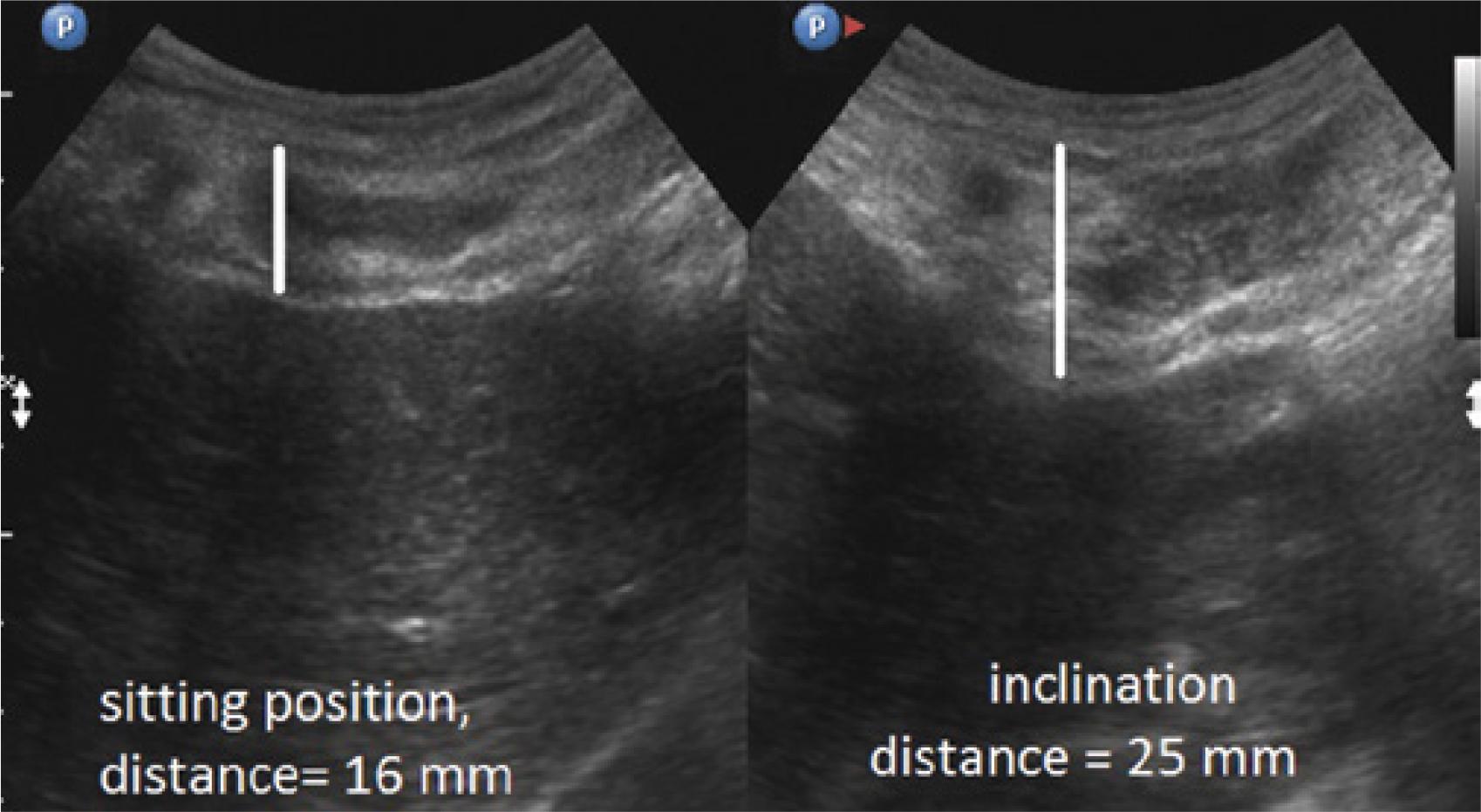 A scheme for the measurement of the musculocartilaginous complex in a patient in sitting position and with forward trunk flexion