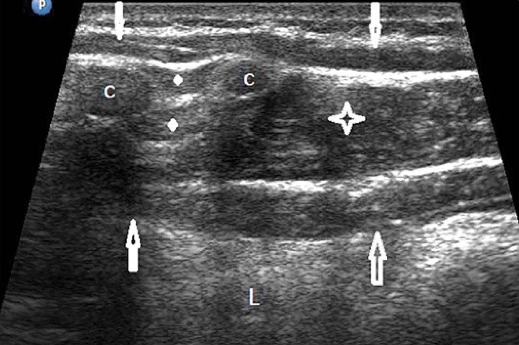 A 20-year-old athlete examined in a supine position during free breathing. Right costal arch area.
Legend: downwards arrows – the external oblique muscle; upwards arrows – the transverse abdominal muscle; asterisk – the internal oblique muscle; a diamond at the top of the figure – the external intercostal muscle; a diamond at the bottom of the figure – the internal intercostal muscle; c – costal cartilages, L – liver
