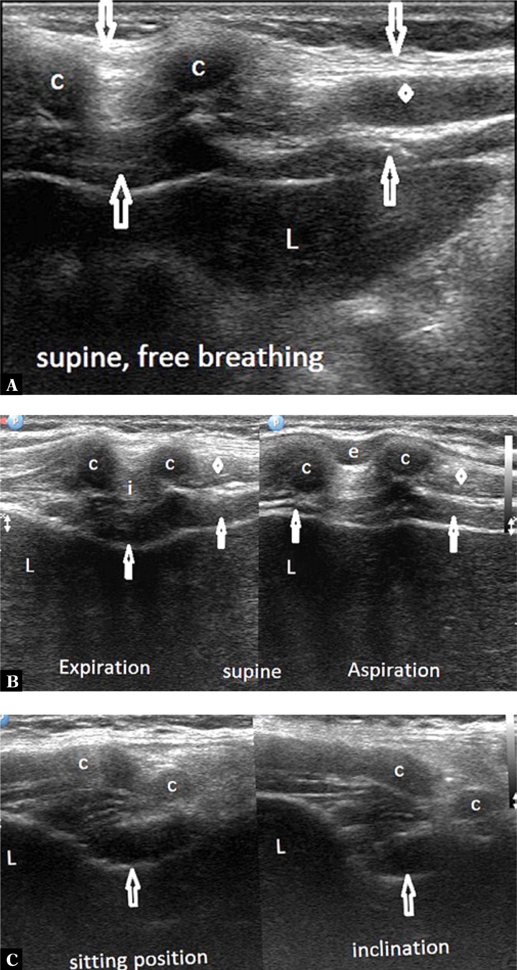 A 26-year-old female. A. Examination in supine position during free breathing: right costal arch area imagined with a 7–12 MHz linear transducer; legend: c – costal cartilages, downwards arrows – the external oblique muscle, upwards arrows – the transverse abdominal muscle, a diamond – the internal oblique muscle, L – liver. B. Examination in supine position: assessment of the musculocartilaginous complex in the dynamic evaluation during deep inhalation and exhalation – on exhalation, a thickening of the transverse abdominal muscle (upwards arrows) and the external oblique muscle (i) occurs, costal cartilages (c) move closer to each another; on inhalation, thinning of the transverse abdominal muscle (upwards arrows) occurs, the tone of the external intercostal muscle with reduced echogenicity increases (e); costal cartilages (c) move away from each other; L – liver. C. Examination in a sitting position and forward trunk flexion: musculocartilaginous compression of the liver is most pronounced in anterior trunk flexion; which is accompanied by costal cartilages being pulled dorsally
