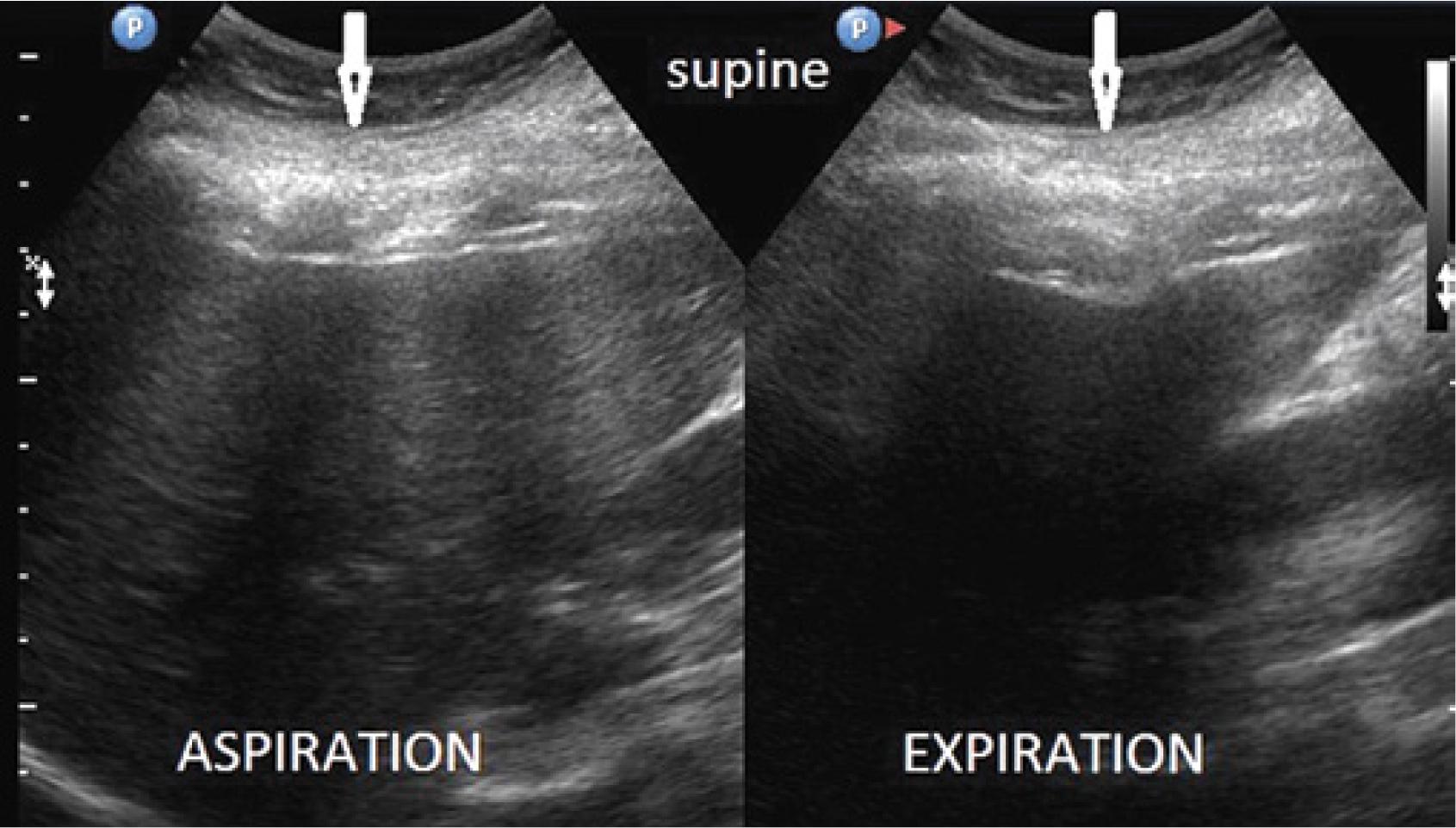 A 46-year-old female examined using a 3–6 MHz convex transducer in a supine position during inhalation and exhalation. Minor musculocartilaginous compression of the liver occurs during exhalation; however, precise determination of musculocartilaginous components is not possible