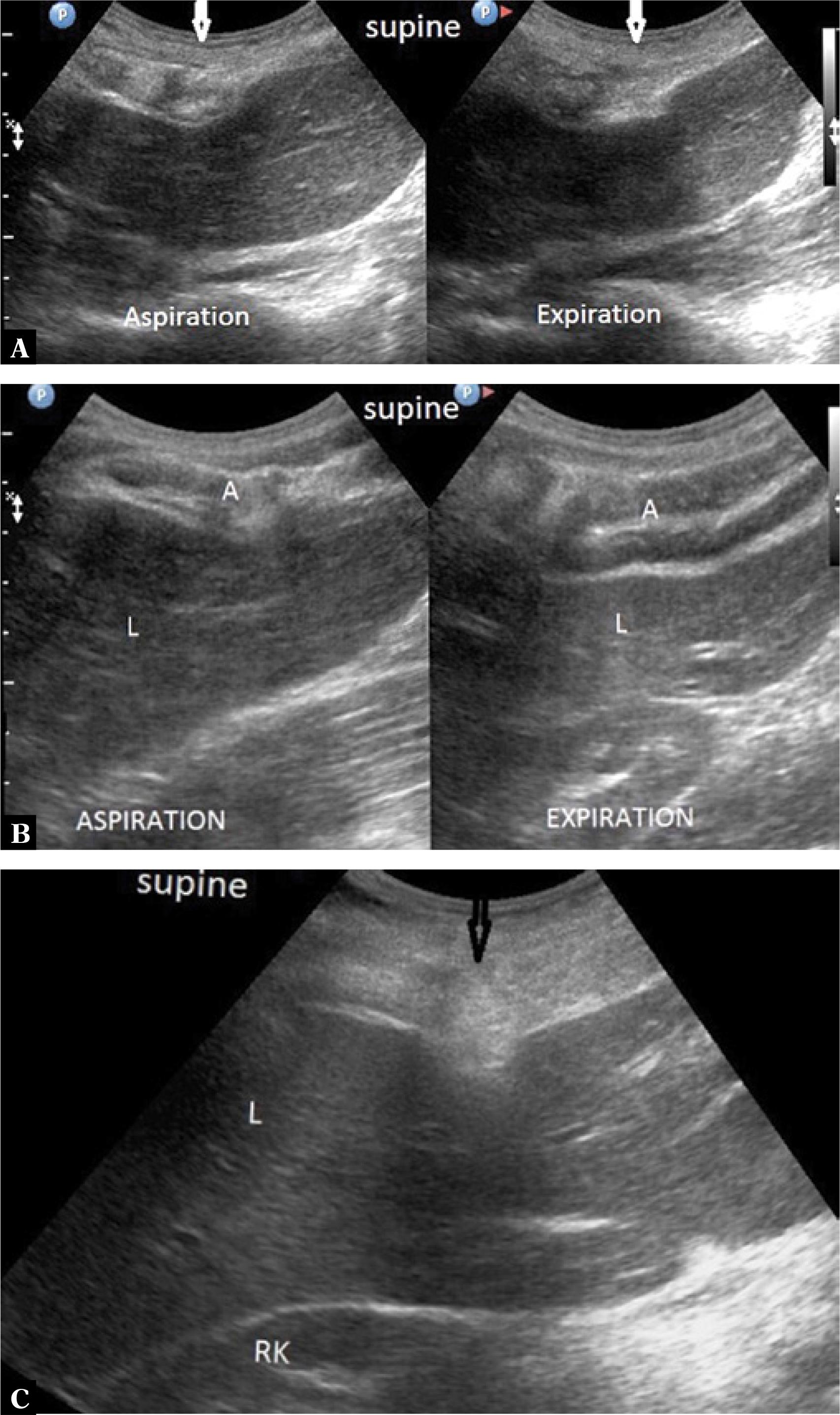 A. The musculocartilaginous complex with inhomogeneous echogenicity during inhalation and exhalation with distinct, moderate liver compression (arrows). B. Hypoechoic musculocartilaginous complex with clear liver compression during exhalation (arrows). C. Highly echogenic musculocartilaginous complex with clear liver compression (arrow)
