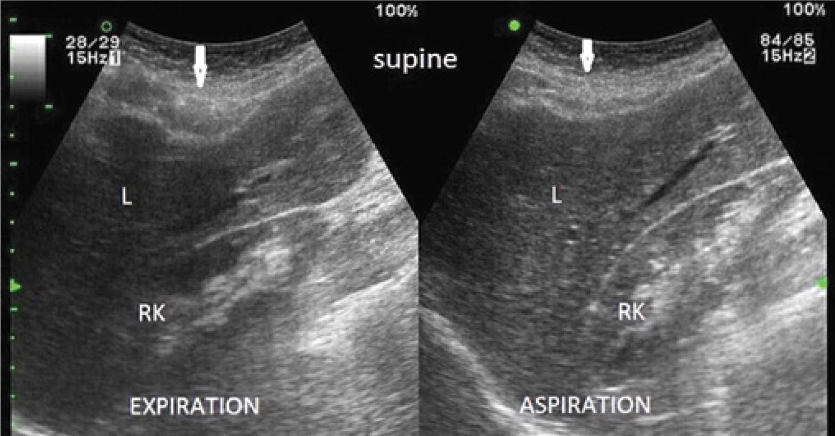 Significantly deeper, focal musculocartilaginous compression of the liver (arrows)