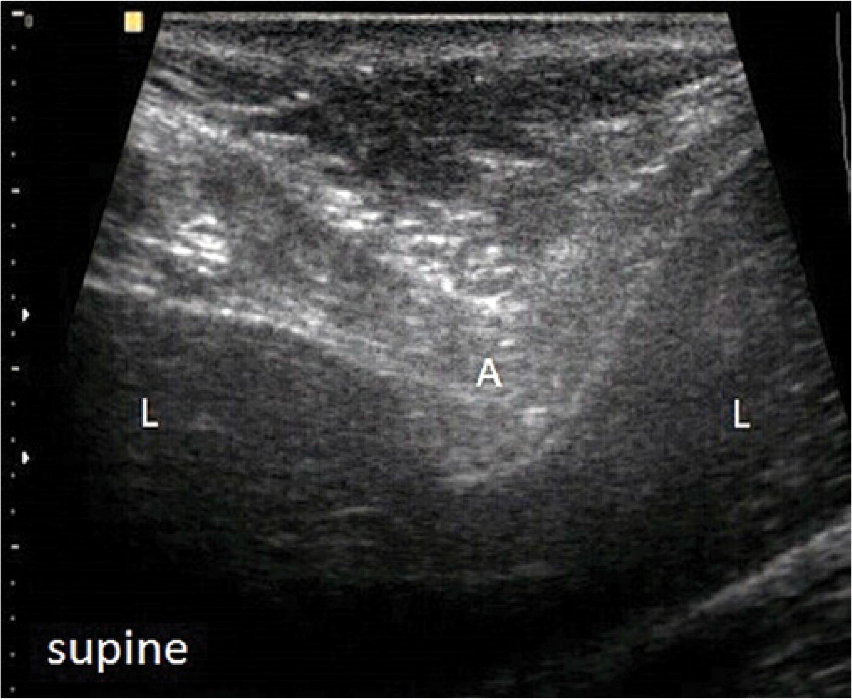 Very deep penetration of the costal arch (A) dividing the liver into two parts (L)