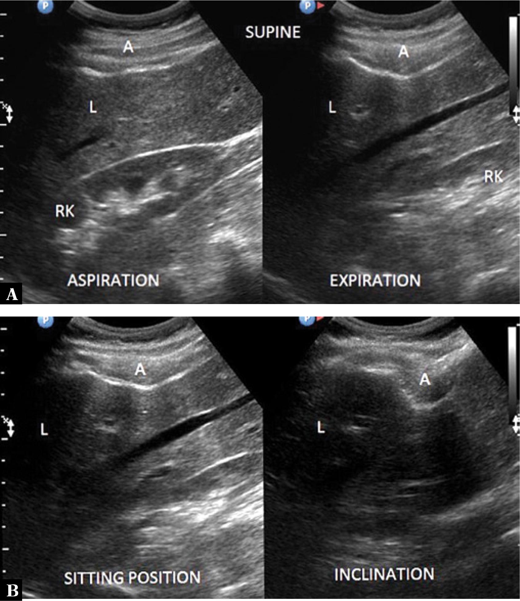 A. Patient in supine position – hepatic compression by the musculocartilaginous complex is deeper during exhalation than inhalation. B. The same patient – in an upright sitting position on the left; in a sitting position with forward trunk flexion on the right – most pronounced hepatic compression