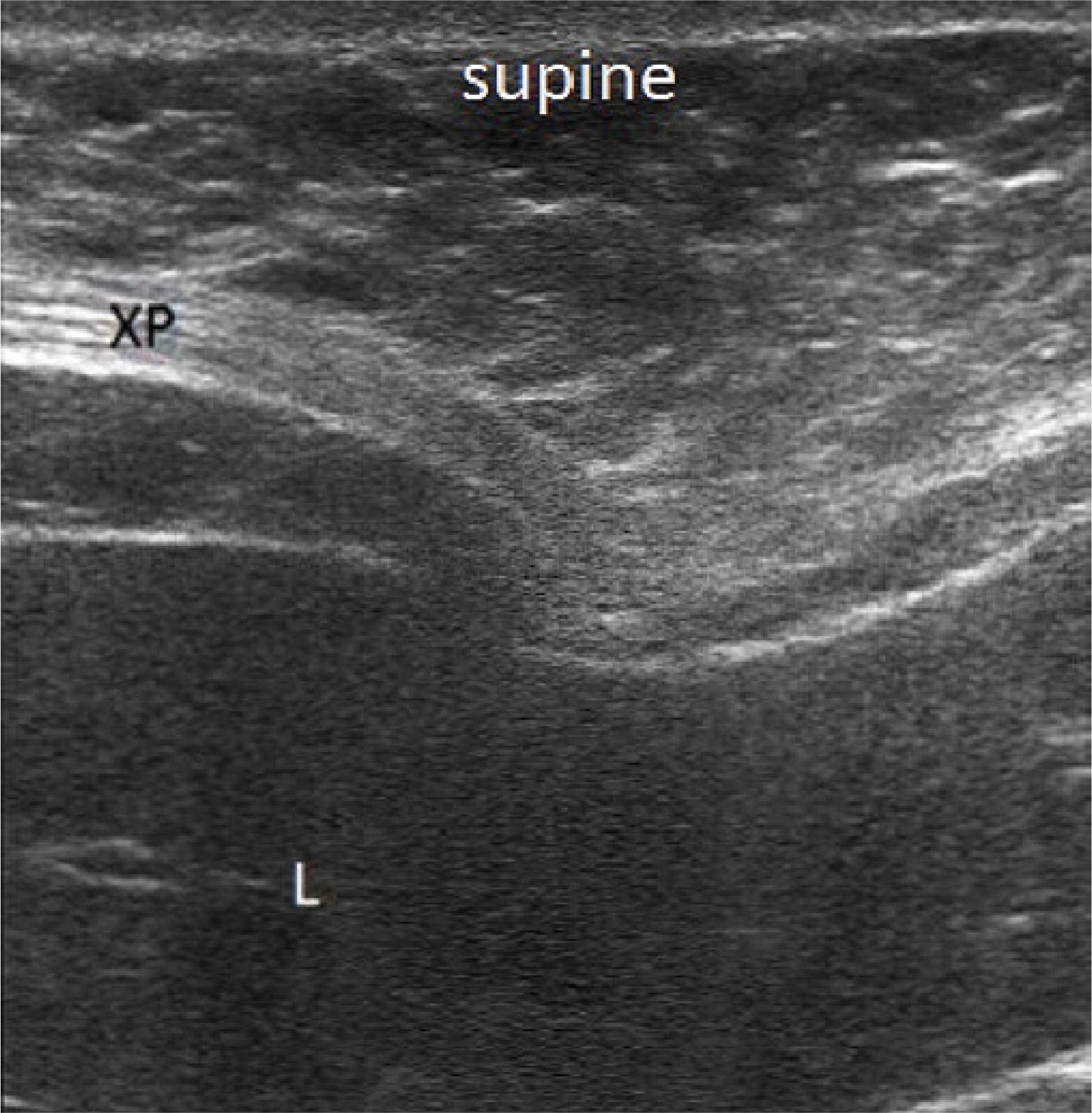 The cartilaginous tip of the xiphoid process (XP) compressing the left hepatic lobe (L)