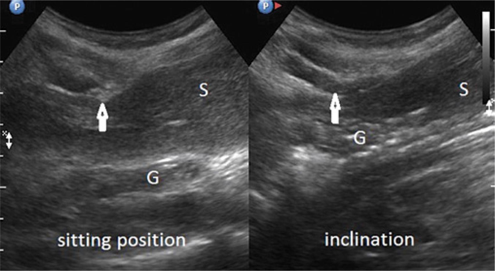 Splenic compression (S) by the musculocartilaginous complex on the left (arrows) in a sitting position (left side of the figure) and forward trunk flexion (right side of the figure); G – stomach