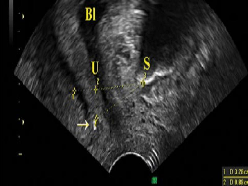 Method for measuring the tape-pubic symphysis parameter (D’O) – a PFS-TV image. S – pubic symphysis, B – bladder, U – urethra, arrow – suburethral sling, 1 – a line drawn along the lower edge of the pubic symphysis, 2 – tape position in the Y axis in relation to the pubic symphysis, 3 – tape position in the X axis in relation to the pubic symphysis, 4 – tape-pubic symphysis distance