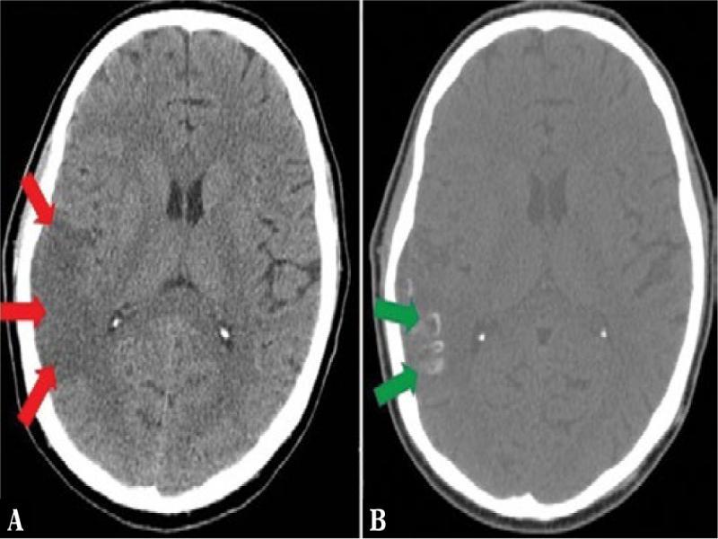 Computed tomography of the head without contrast-enhancement. A. Red arrows indicate a large, hypodense region corresponding to an ischemic focus within the temporal lobe. B. Follow-up after 25 days of treatment: a cortical-subcortical focus of ischemic stroke within the right temporal lobe with calcifications on the cortex outlines