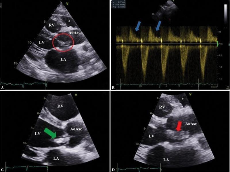 Transthoracic echocardiography. A. Sternal, long-axis view: a structure linked with aortic valve cusps, corresponding to a vegetation. B. Suprasternal view with blood flow assessment in the descending aorta using pulsed Doppler: arrows indicate holodiastolic flow indicating considerable regurgitation. C and D. Parasternal, long-axis views, zoomed aortic valve (ZOOM): changes in the position of the vegetation depending on the cardiac cycle: systole (
C
), diastole (
D
). AoAsc – ascending aorta, LA – left atrium, LV – left ventricle, RV – right ventricle, * – pericarcial fluid