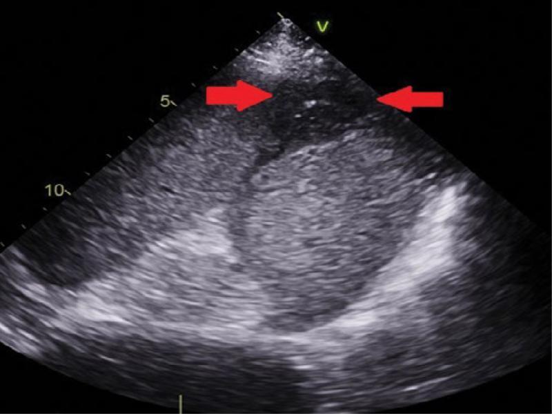 Abdominal ultrasound with a sector echocardiography transducer: a triangular area of infarction in the spleen (also seen in computed tomography of the abdomen shown in Fig. 2A)