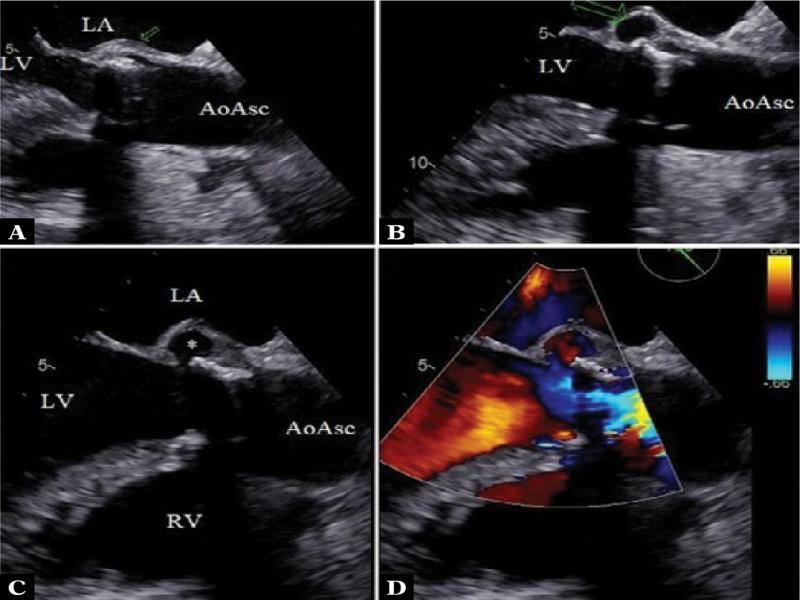 Echocardiography, high transesophageal view, long axis. A. 35 days after aortic valve replacement: a thickening seen at the site of valvular prosthesis implantation. B. 54 days after surgery: a slight paravalvular aneurysm is seen at the site of previous wall thickening. C. Clearly visible inflow gate: the aneurysm communicates with the left ventricular outflow tract. D. Color Doppler presents evidence of flow within the lesion. Abbreviations: AoAsc – ascending aorta, LA – left atrium, LV – left ventricle, RV – right ventricle, * – a space corresponding to the paravalvular aneurysm