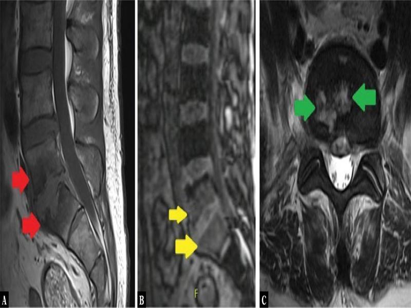 Magnetic resonance imaging of the lumbosacral spine. A. A low-signal region on T1-weighted images within the L5 and S1 vertebral bodies. B and C. Arrows indicate areas of increased signal on T2-weighter images
