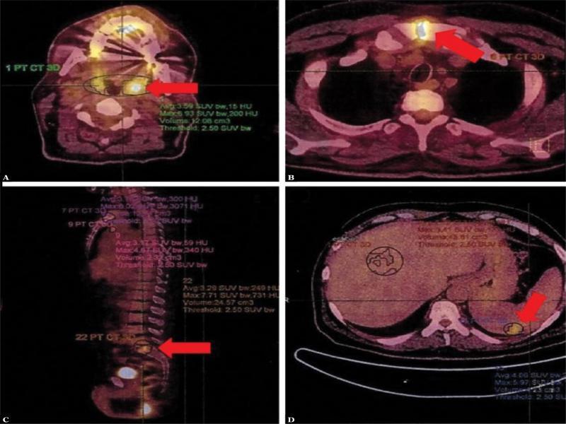 18-fluorodeoxyglucose positron emission tomography. A. Enhanced tracer accumulation within the palatine tonsils. B. Enhanced and diffuse tracer accumulation in the superior part of the mesosternum: the findings correspond to the healing process after sternotomy. C. Diffuse area of enhanced tracer accumulation within the L5/S1 vertebral bodies: the entire image suggests inflammatory nature of the lesions. D. A peripheral, subcapsular region of enhanced tracer accumulation in the spleen. It corresponds to an infarction focus seen also on abdominal ultrasound (Fig. 4) and computed tomography (Fig. 2A)