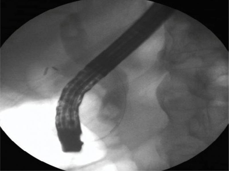 Initial cholangiogram revealing two 8 mm stones in the common bile duct