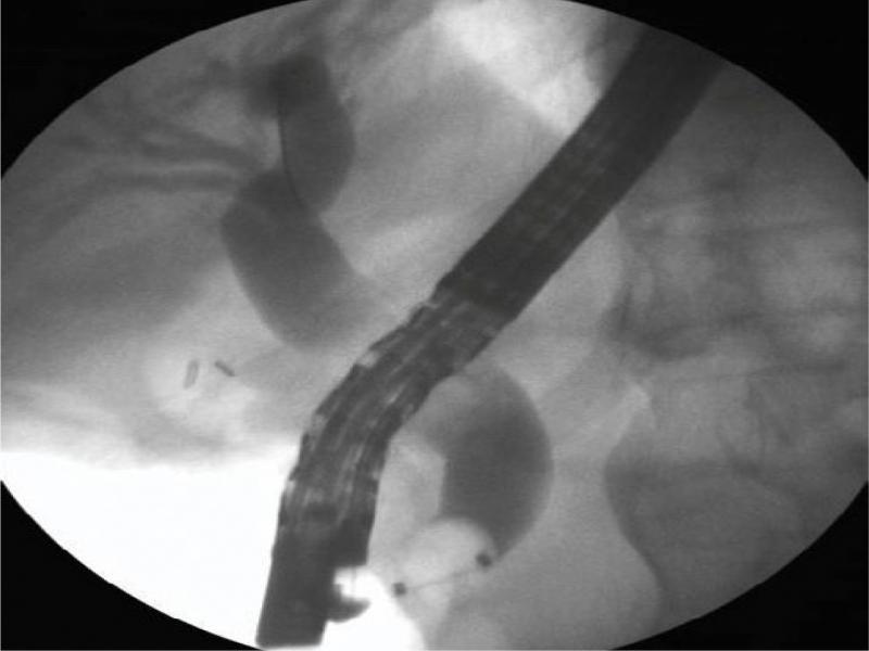 Control cholangiogram at the end of the ERCP procedure confirming stone clearance. No obvious radiologic signs of perforation were seen by the examiner