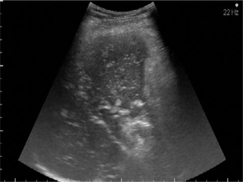 Echogenic particles flowing within the portal vein and inferior vena cava, and multiple non-shadowing echogenic foci within the liver parenchyma consistent with the presence of intrahepatic portal venous gas