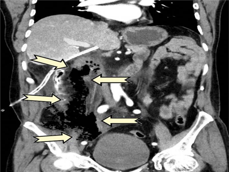 Contrast-enhanced CT scan of the abdomen performed 4 hours after the second abdominal ultrasound examination showing massive retropneumoperitoneum (arrows) and a post-cholecystectomy drainage tube. Gas is no longer visible in the liver or portal venous system
