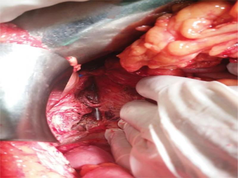 Image of the retroperitoneal cavity taken during the surgical intervention