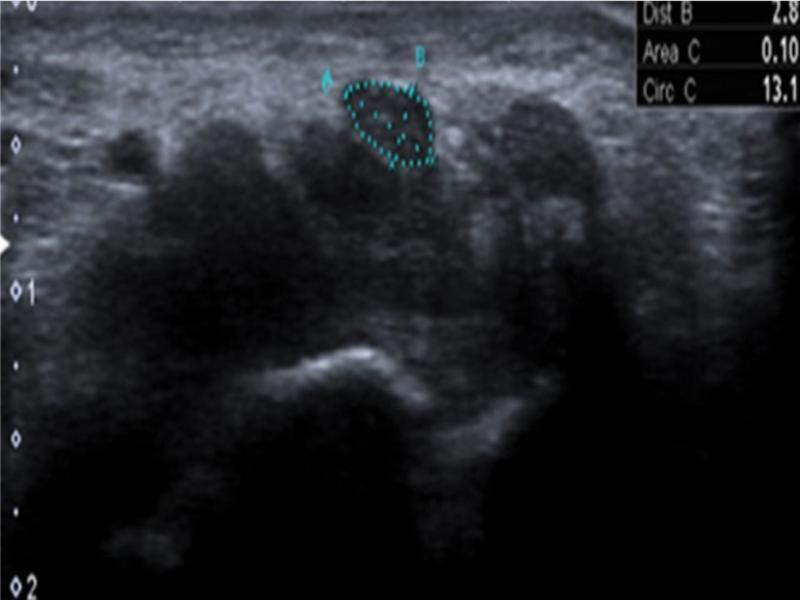 Transverse view of the median nerve on conventional B-mode ultrasonography as acquired from a 45-year-old patient. ROI was drawn manually. The area of the median nerve (CSA) was measured as 0.10 cm2