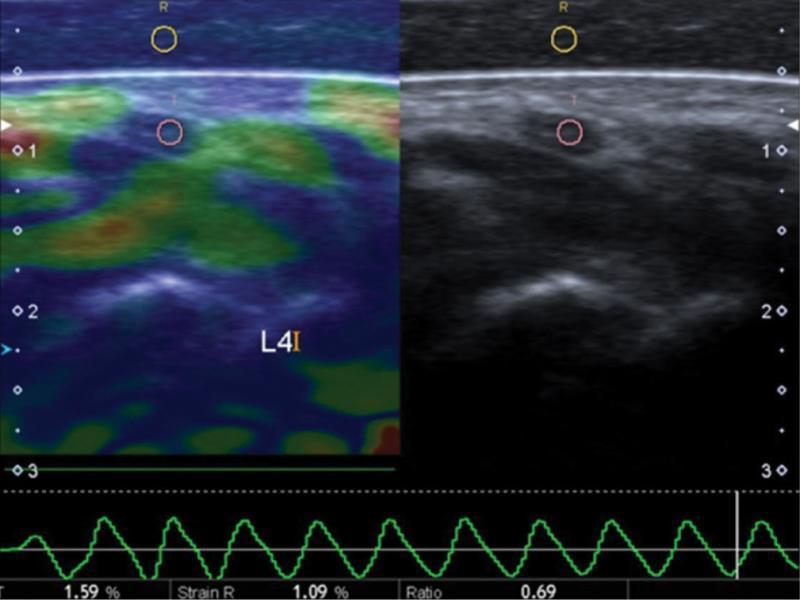 Transverse SE image of a median nerve acquired from a 50-year-old female with mild CTS. SE was performed at the scaphoid-pisiform level. Circular ROIs were placed manually