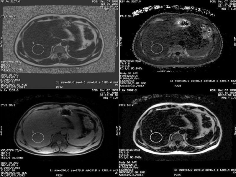 The images were processed by using the software provided by the manufacturer (IDEAL-IQ; GE Healthcare) which created water, fat, R2* maps and PDFF parametric map representing fat mapping of the entire liver. ROI was placed in hepatic segment VI