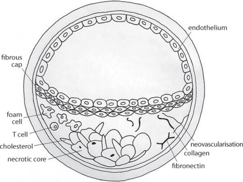 Atherosclerotic plaque with signs of neovascularisation: a diagram