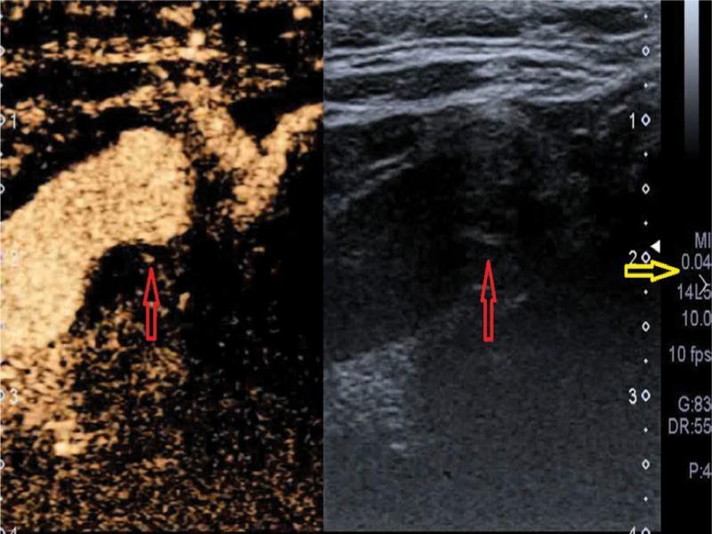 CEUS, arterial phase, vessel lumen filling: well visible vessel lumen–plaque boundary; red arrow – plaque neovessel; yellow arrow – mechanical index value (present authors’ own material)